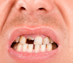 A close-up of a person’s mouth showing severely misaligned, chipped, and broken teeth with visible gums and a light mustache.