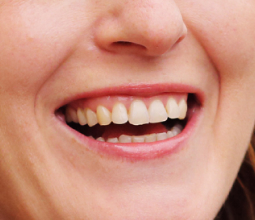 A close-up of a smiling person's mouth showing their upper teeth, with slightly uneven tooth alignment and a healthy pink gumline.