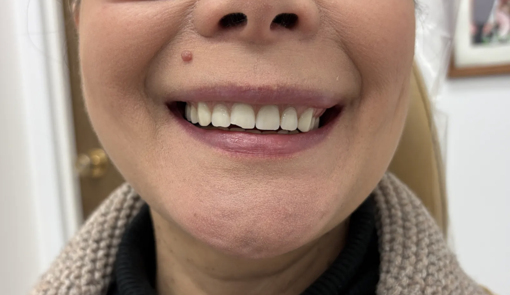Woman smiling with natural-looking upper dentures