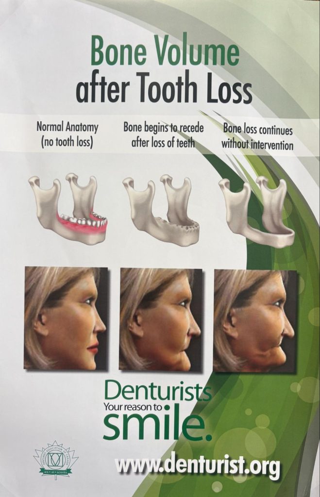 Educational poster showing bone loss progression after tooth extraction