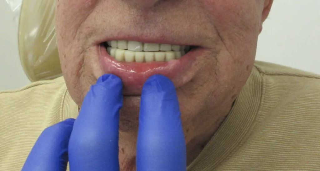 Worn Denture with Jaw Protrusion – Denture Replacement Signs
